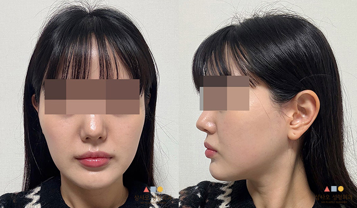 수술 후