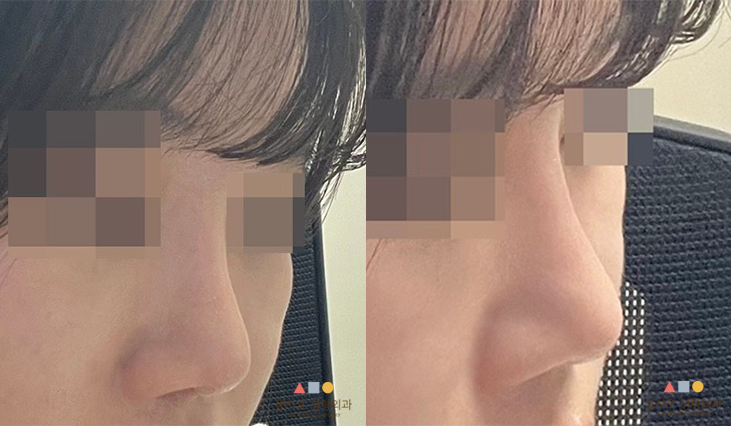 수술 후