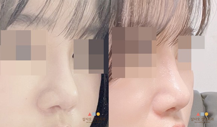 수술 후