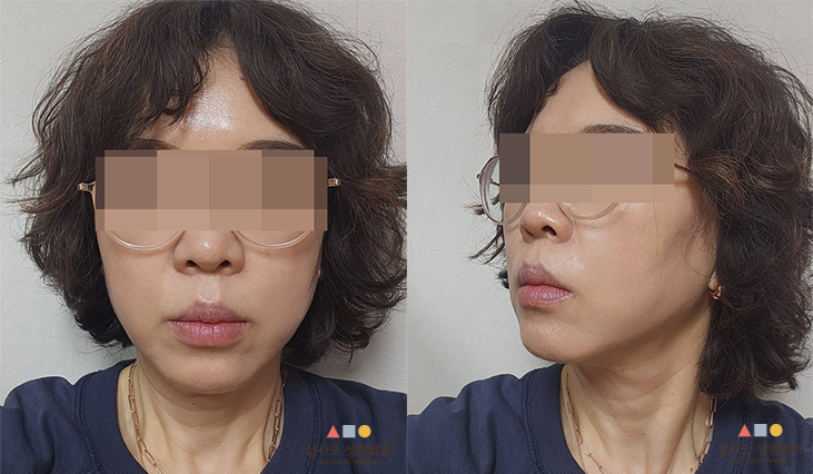 수술 후