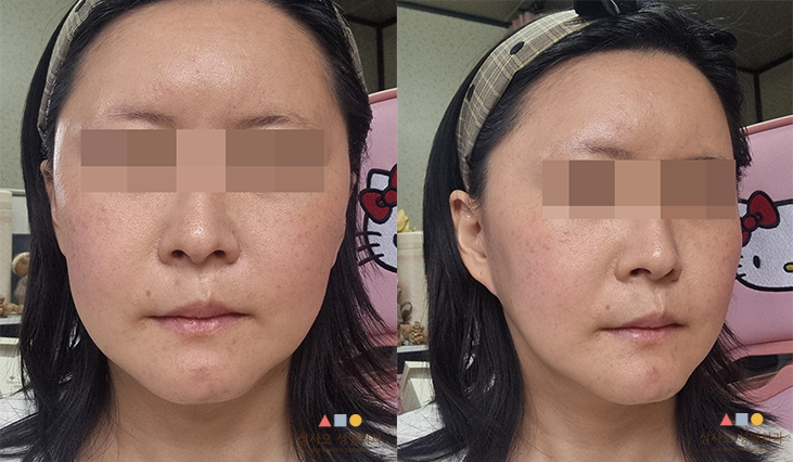 수술 전