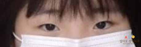 수술 전