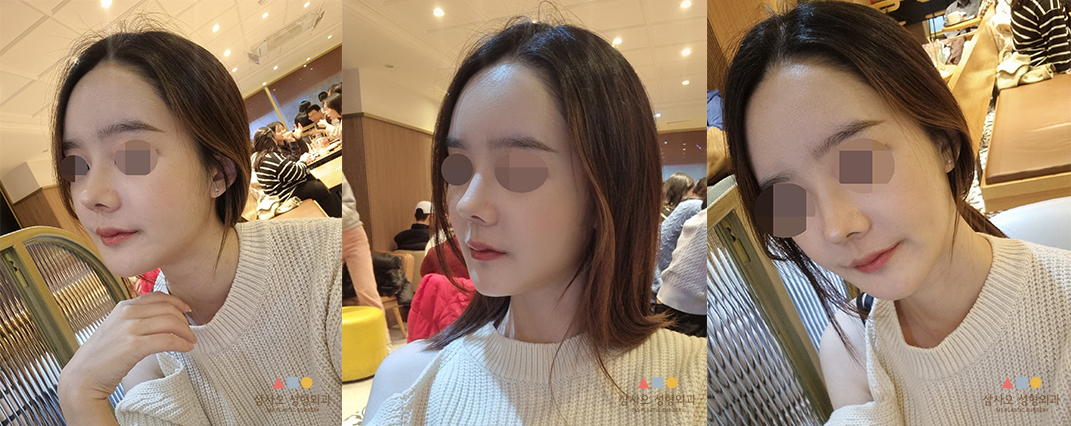 수술 후