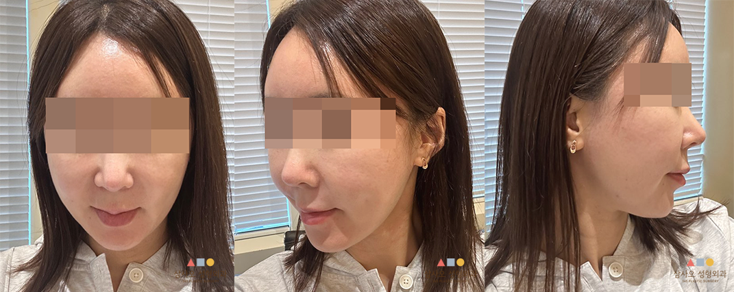 수술 후