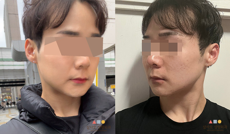 수술 후