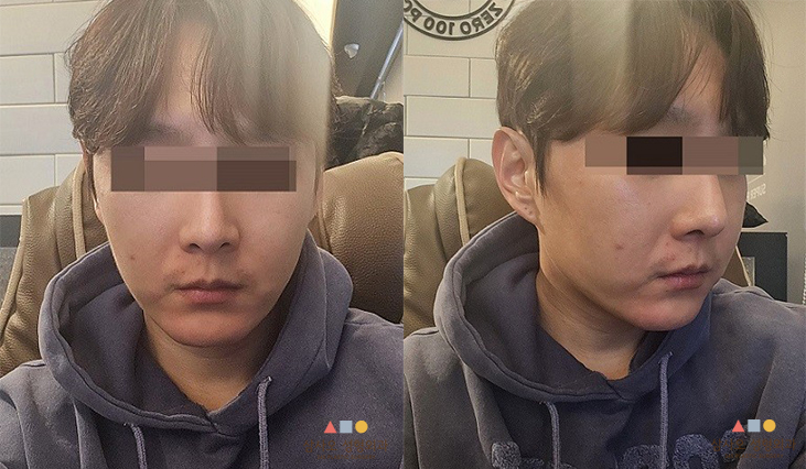 수술 후