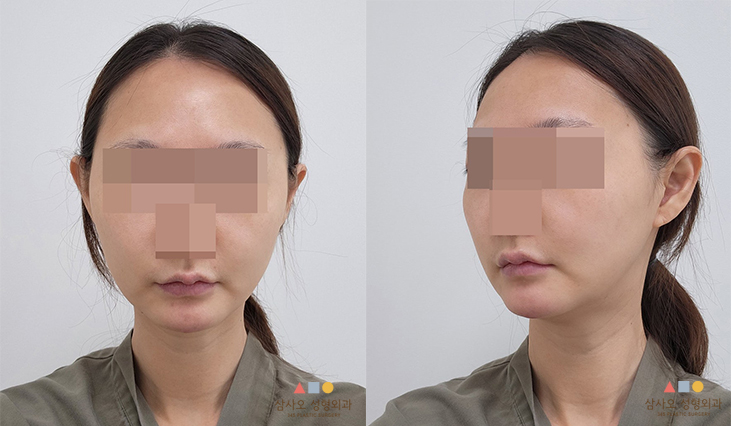 수술 전