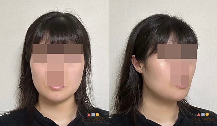 수술 후