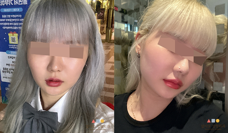 수술 전