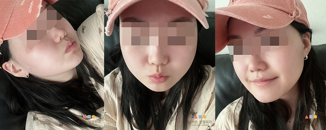 수술 후