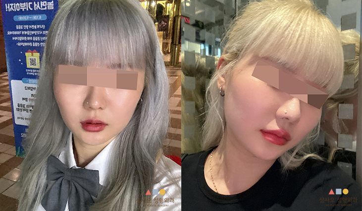 수술 전