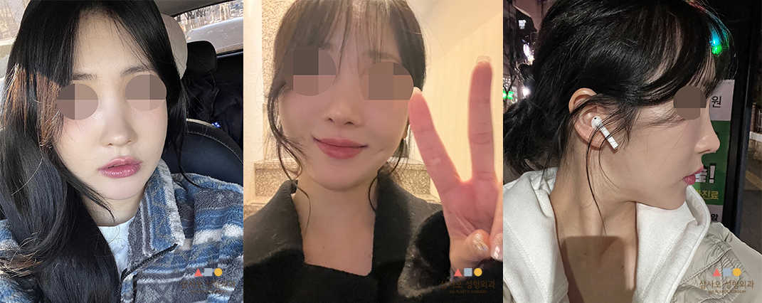 수술 후