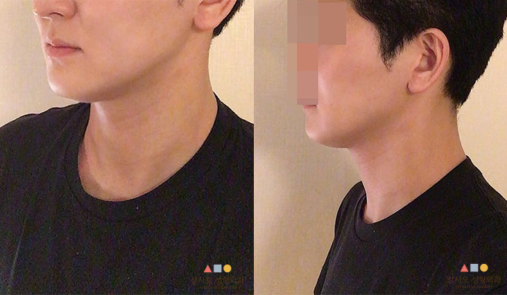 수술 후