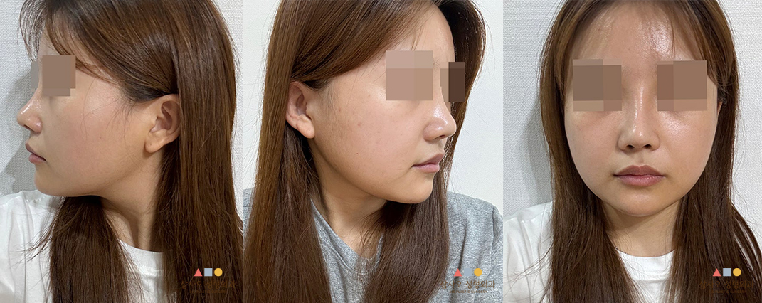 수술 후
