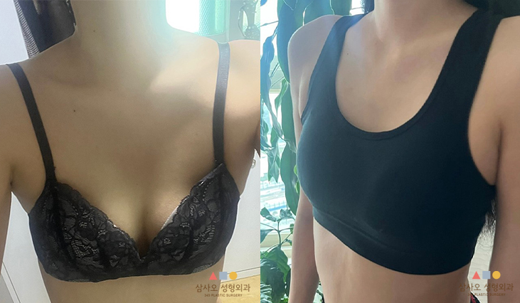 수술 전