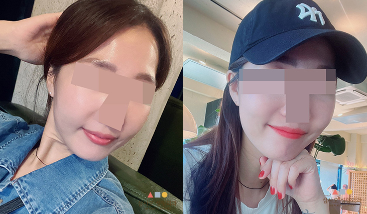 수술 후
