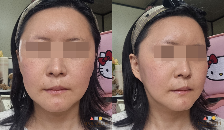 수술 전