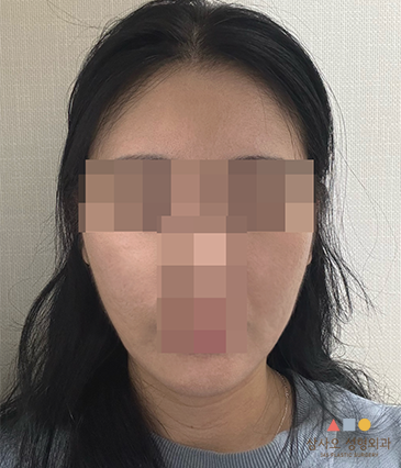수술 후
