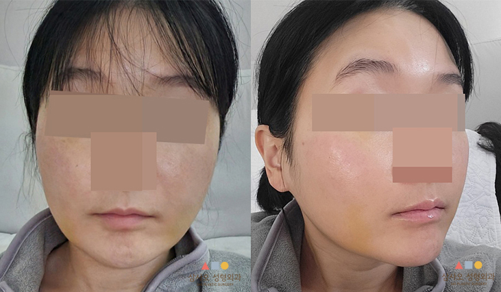 수술 후