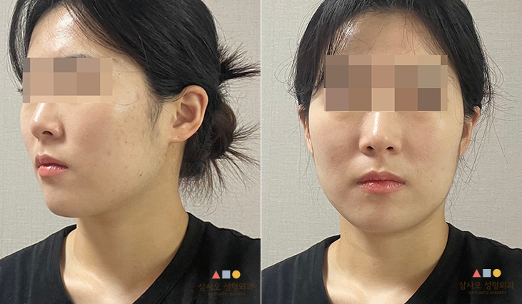 수술 전