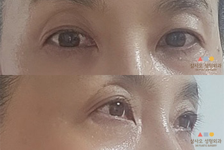 수술 후