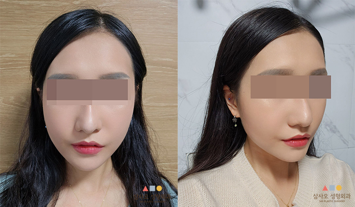 수술 후