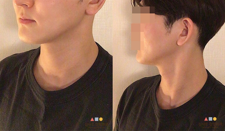 수술 전