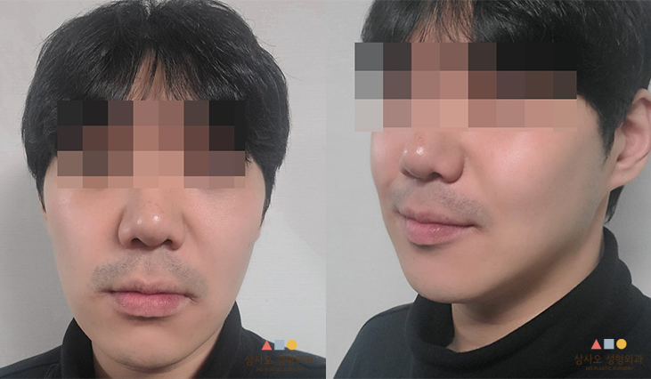수술 후