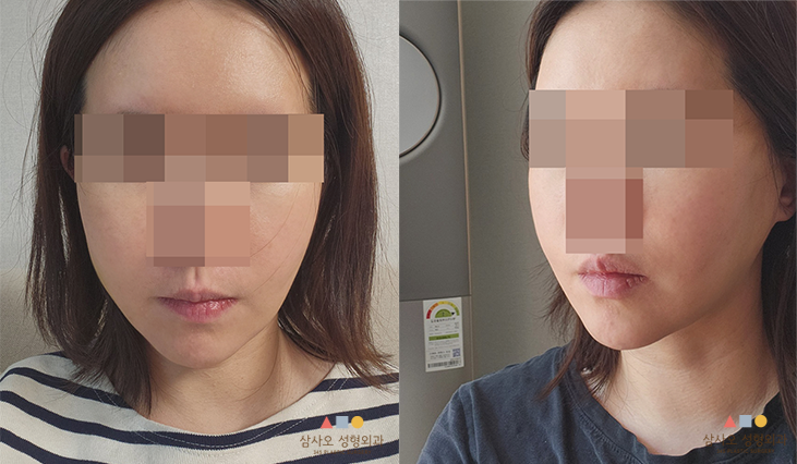 수술 후