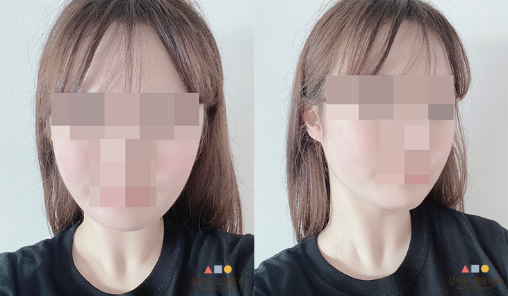 수술 후