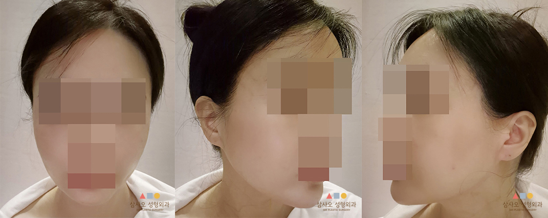 수술 후