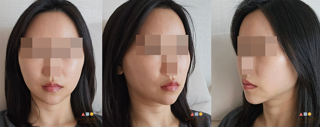 수술 후