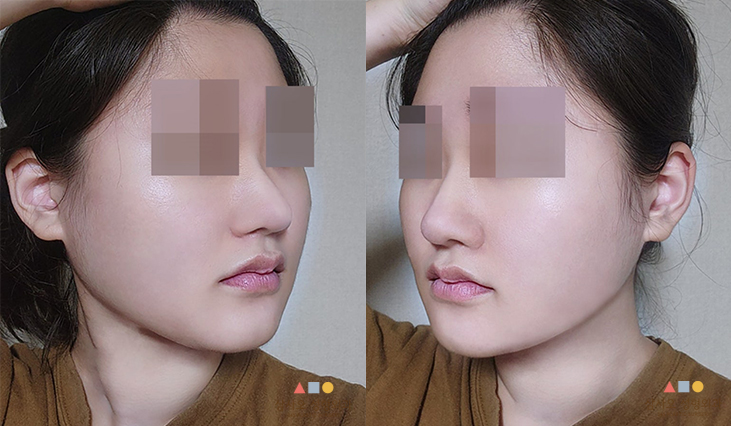 수술 후