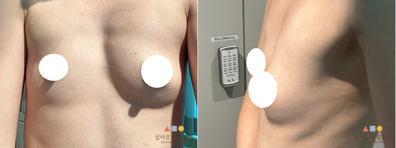 수술 전