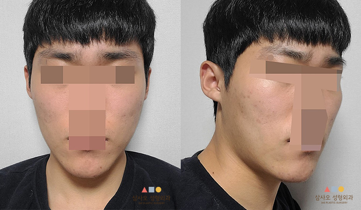 수술 전