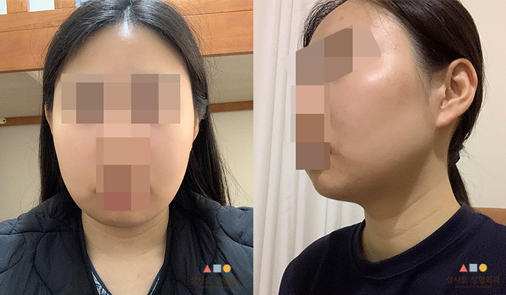 수술 후