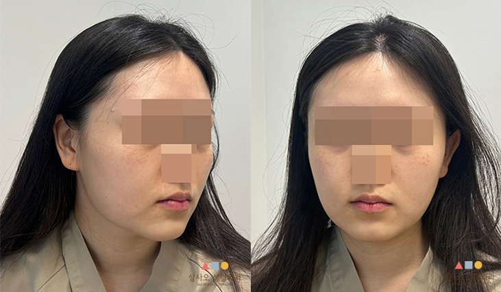 수술 전