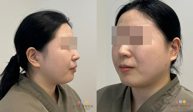 수술 전