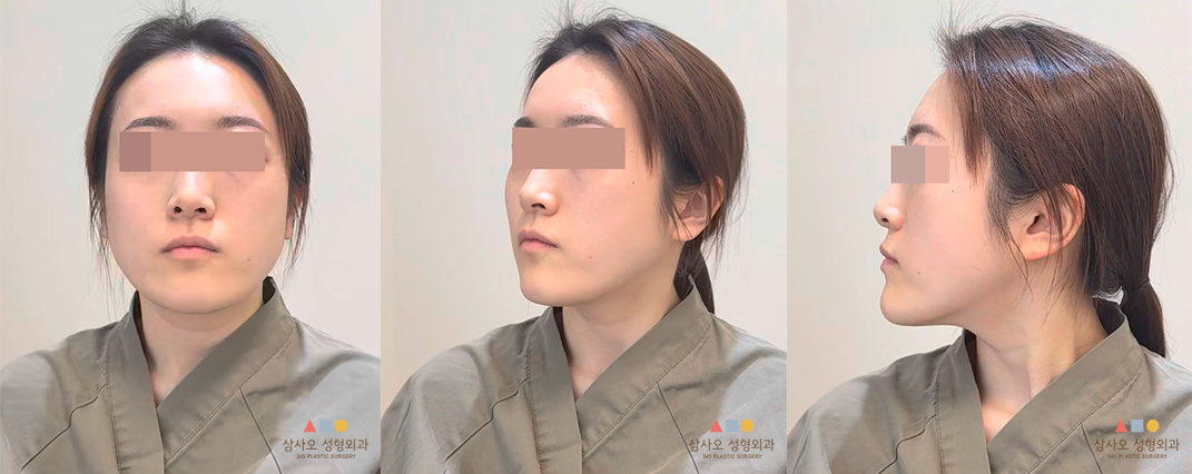 수술 전