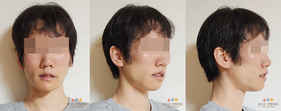 수술 후