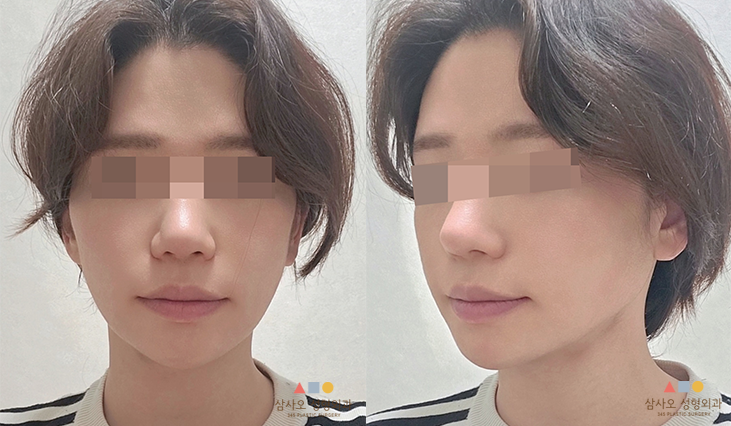 수술 후