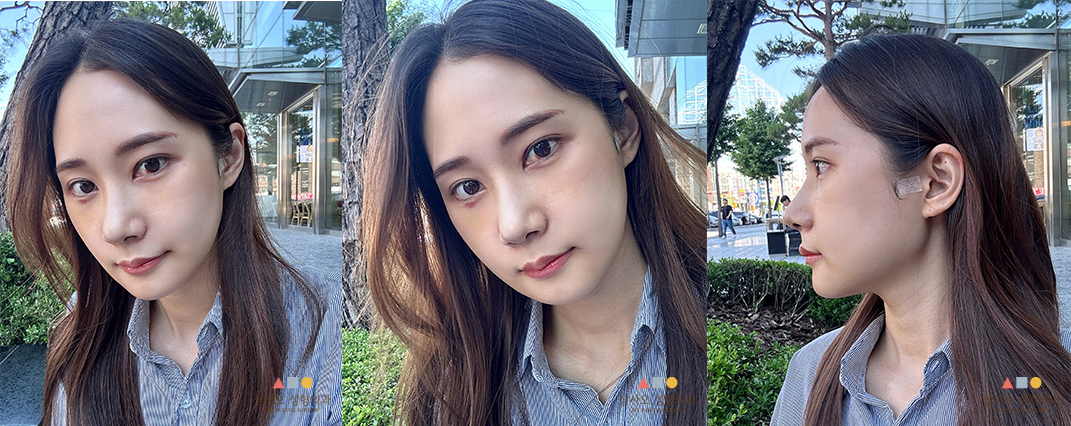 수술 후
