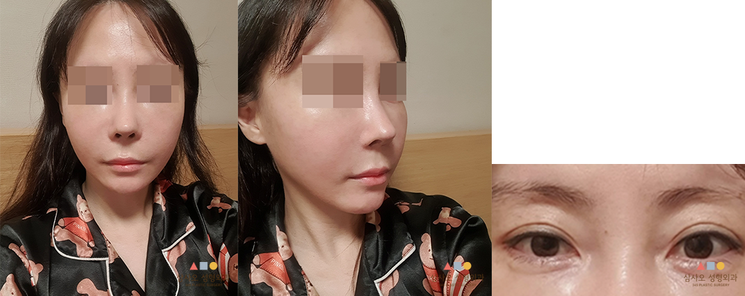 수술 후
