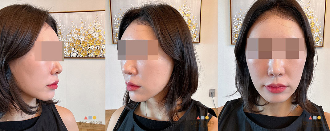 수술 후