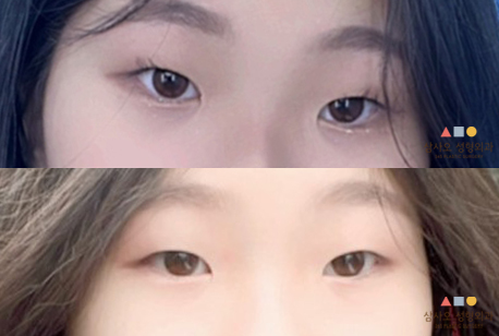 수술 전