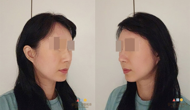 수술 후