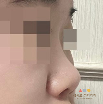 수술 전
