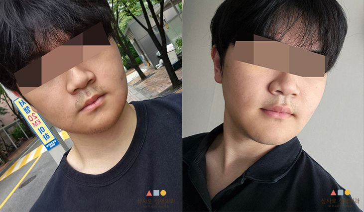 수술 후