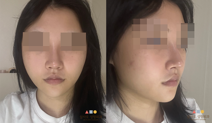 수술 후