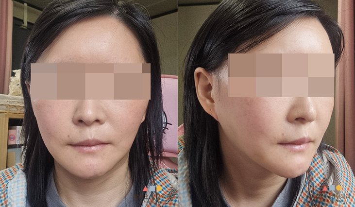 수술 후